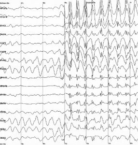 spike waves on an EEG